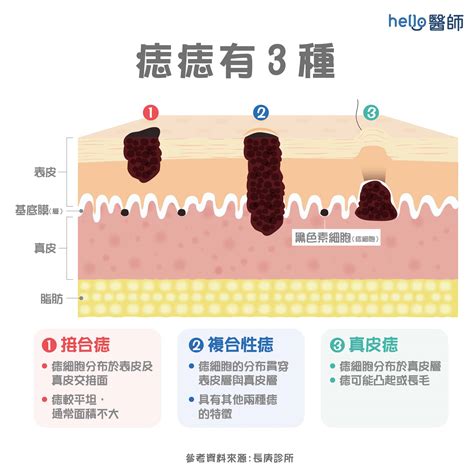 身體上的痣|為什麼臉上的痣越來越多？皮膚科醫師解析長痣原因、。